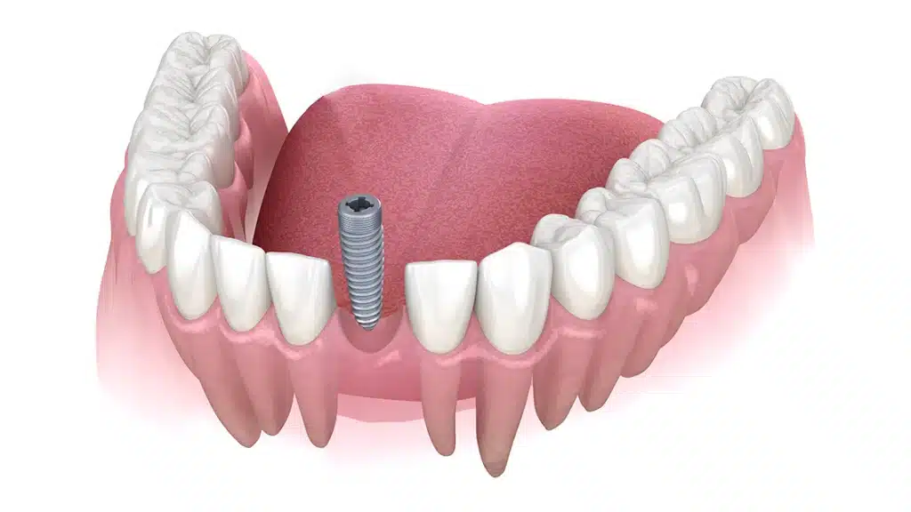 Single-Tooth Implant Cost